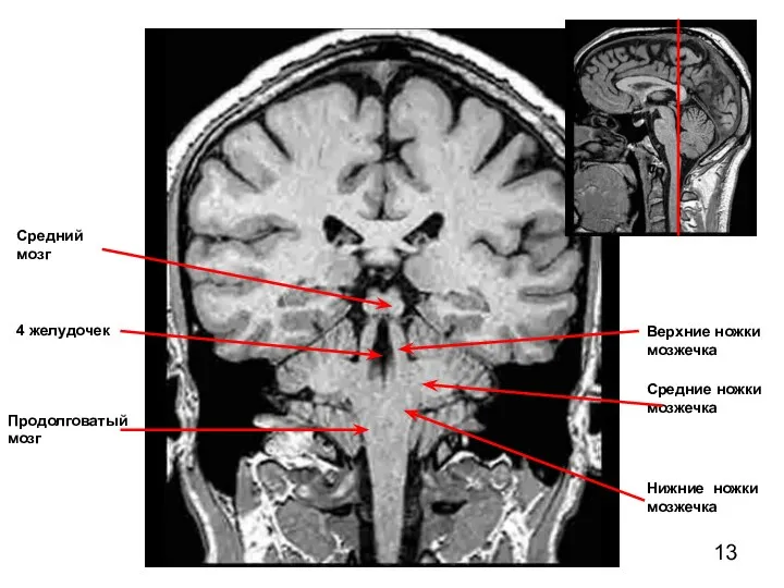Средний мозг Верхние ножки мозжечка Продолговатый мозг 4 желудочек Средние ножки мозжечка Нижние ножки мозжечка