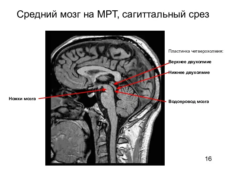 Средний мозг на МРТ, сагиттальный срез Ножки мозга Пластинка четверохолмия: Верхнее двухолмие Нижнее двухолмие Водопровод мозга