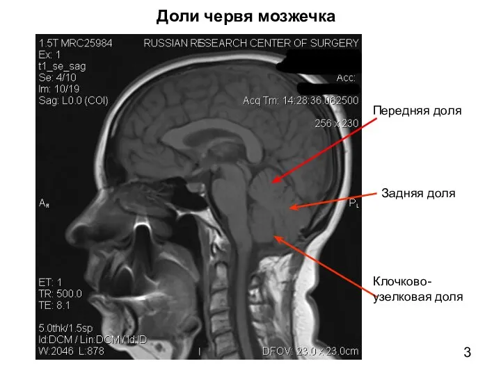 Доли червя мозжечка Передняя доля Задняя доля Клочково-узелковая доля