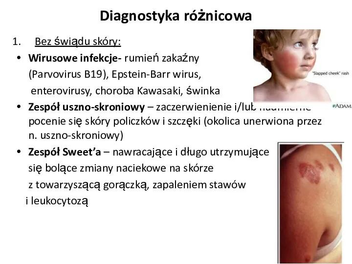 Diagnostyka różnicowa Bez świądu skóry: Wirusowe infekcje- rumień zakaźny (Parvovirus