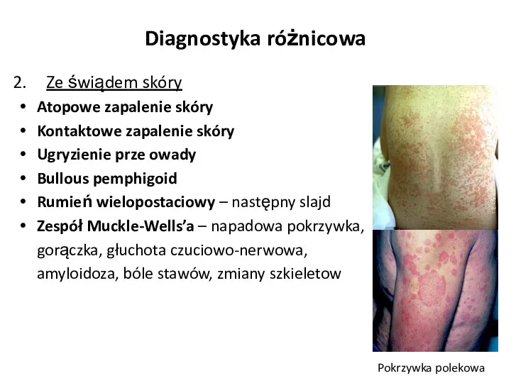 Diagnostyka różnicowa Ze świądem skóry Atopowe zapalenie skóry Kontaktowe zapalenie