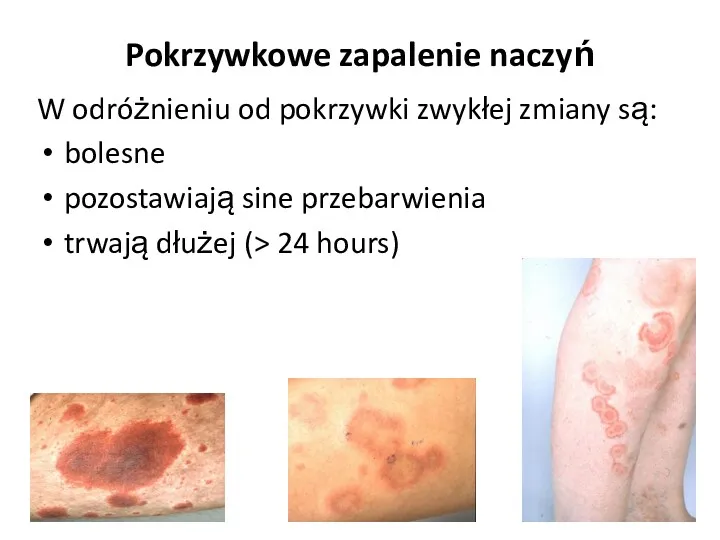 Pokrzywkowe zapalenie naczyń W odróżnieniu od pokrzywki zwykłej zmiany są: