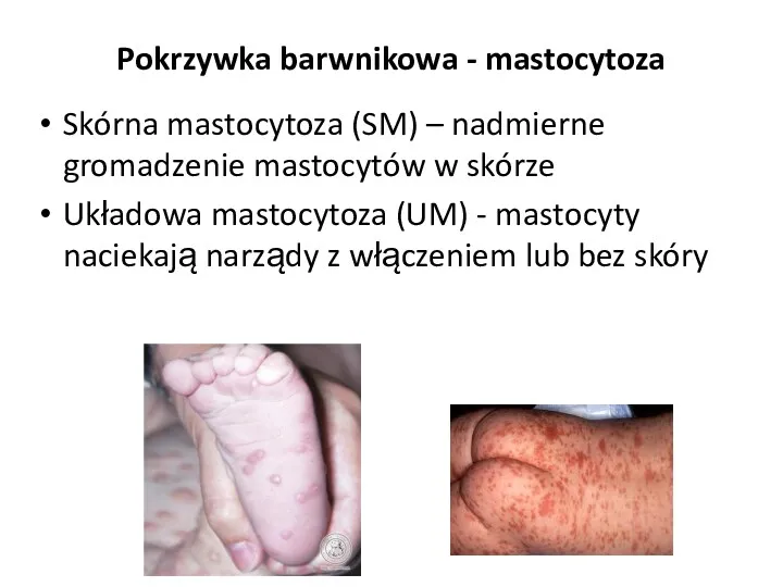 Pokrzywka barwnikowa - mastocytoza Skórna mastocytoza (SM) – nadmierne gromadzenie