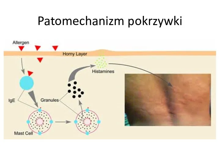 Patomechanizm pokrzywki