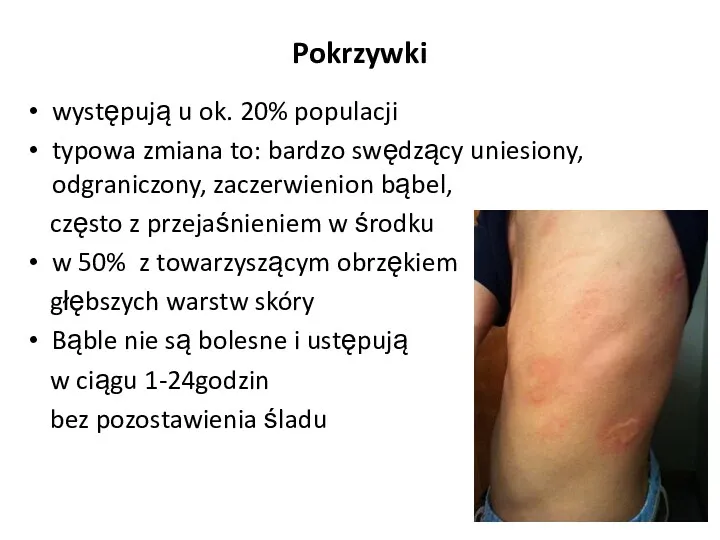 Pokrzywki występują u ok. 20% populacji typowa zmiana to: bardzo