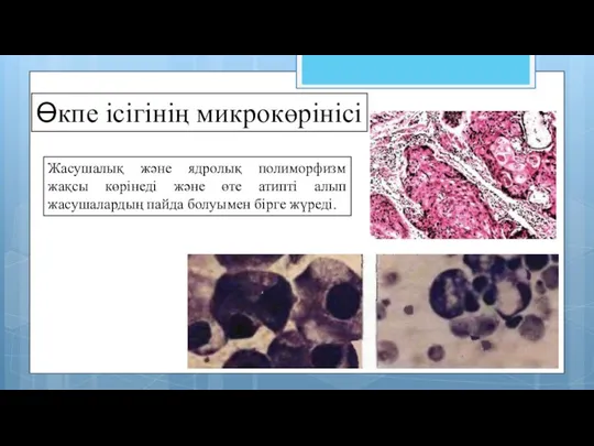 Жасушалық және ядролық полиморфизм жақсы көрінеді және өте атипті алып жасушалардың пайда болуымен