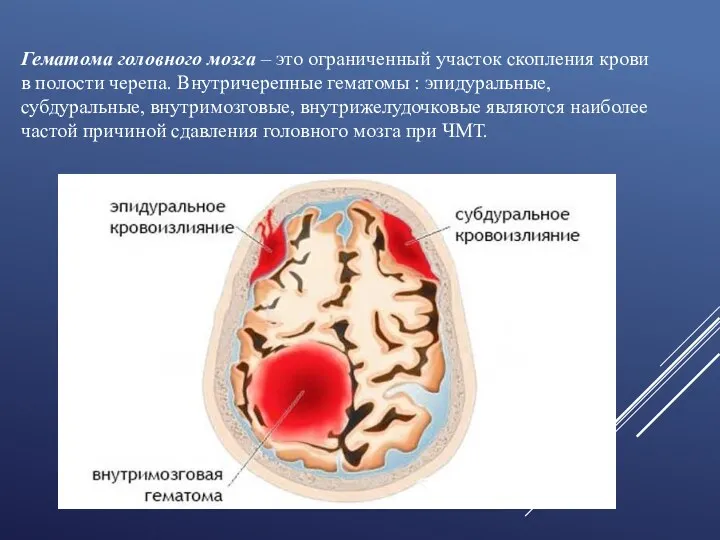 Гематома головного мозга – это ограниченный участок скопления крови в
