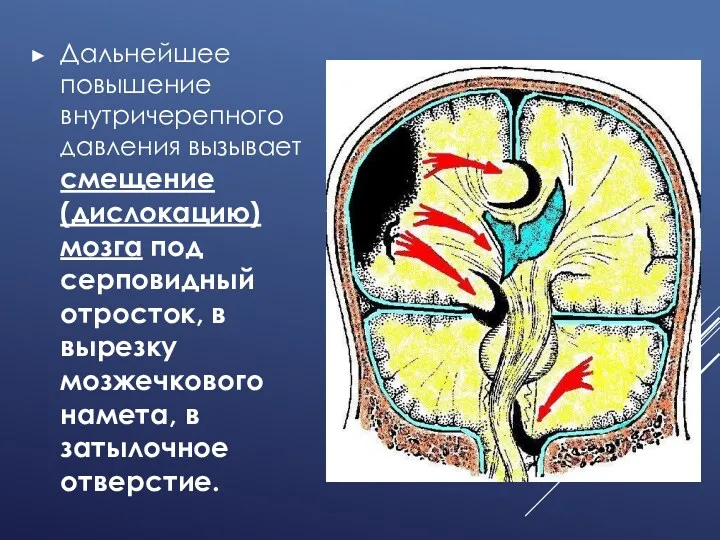 Дальнейшее повышение внутричерепного давления вызывает смещение (дислокацию) мозга под серповидный