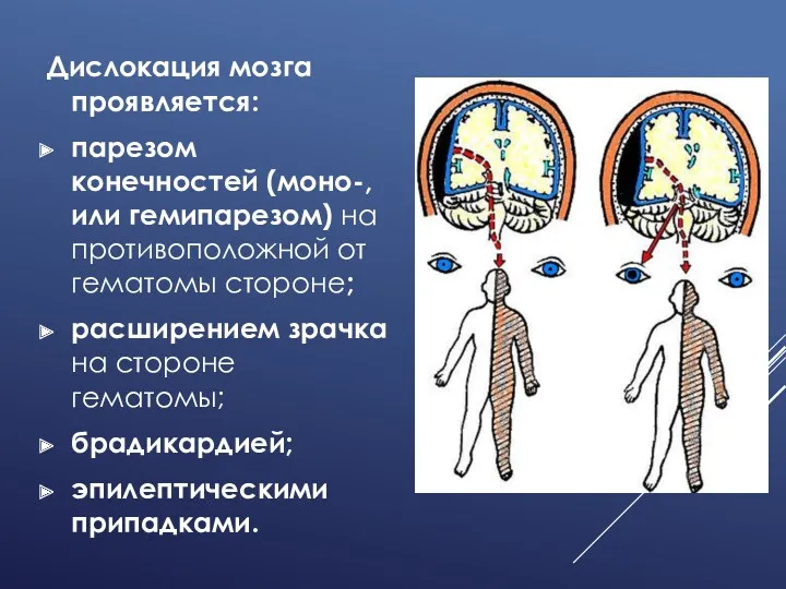 Дислокация мозга проявляется: парезом конечностей (моно-, или гемипарезом) на противоположной