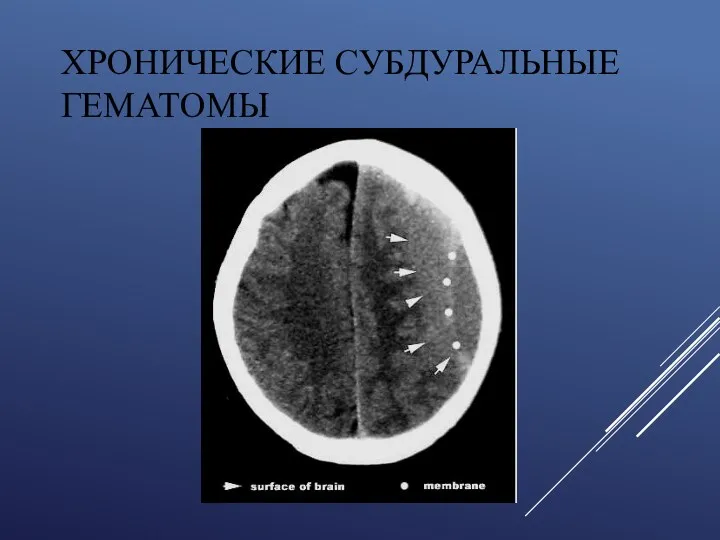 ХРОНИЧЕСКИЕ СУБДУРАЛЬНЫЕ ГЕМАТОМЫ