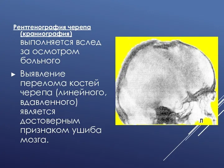 Рентгенография черепа (краниография) выполняется вслед за осмотром больного Выявление перелома