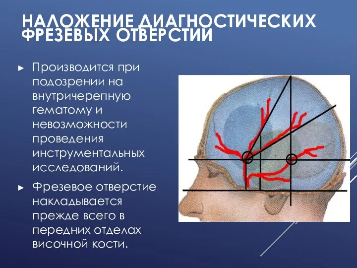 НАЛОЖЕНИЕ ДИАГНОСТИЧЕСКИХ ФРЕЗЕВЫХ ОТВЕРСТИЙ Производится при подозрении на внутричерепную гематому