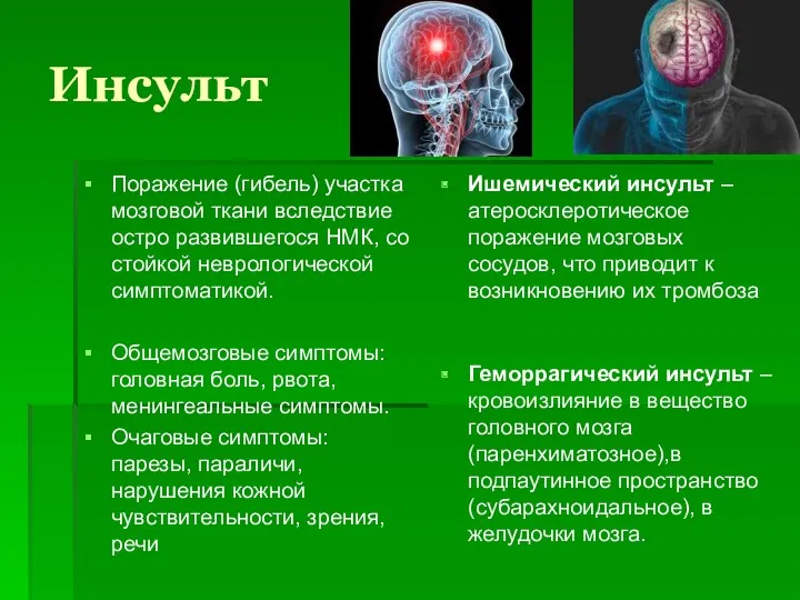 Инсульт Поражение (гибель) участка мозговой ткани вследствие остро развившегося НМК,