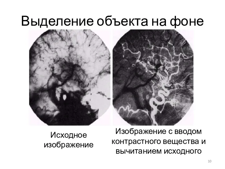 Выделение объекта на фоне Исходное изображение Изображение с вводом контрастного вещества и вычитанием исходного