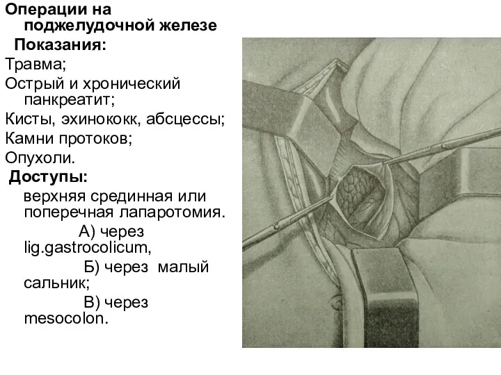 Операции на поджелудочной железе Показания: Травма; Острый и хронический панкреатит;