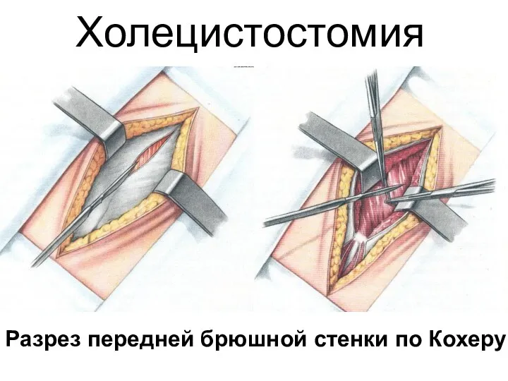 Холецистостомия Разрез передней брюшной стенки по Кохеру