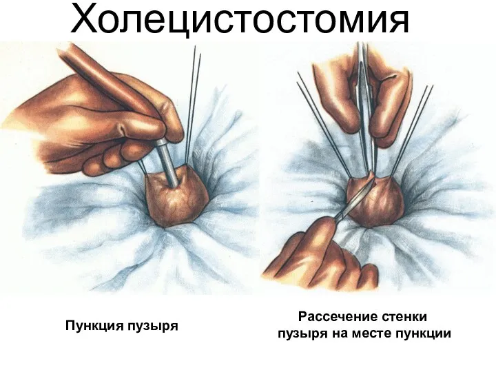 Холецистостомия Пункция пузыря Рассечение стенки пузыря на месте пункции