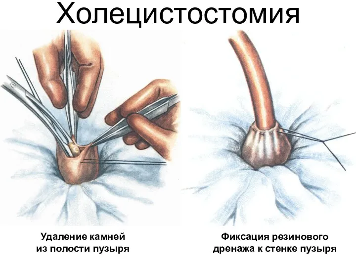 Холецистостомия Удаление камней из полости пузыря Фиксация резинового дренажа к стенке пузыря