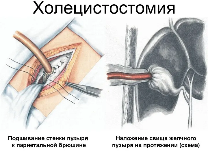 Холецистостомия Подшивание стенки пузыря к париетальной брюшине Наложение свища желчного пузыря на протяжении (схема)