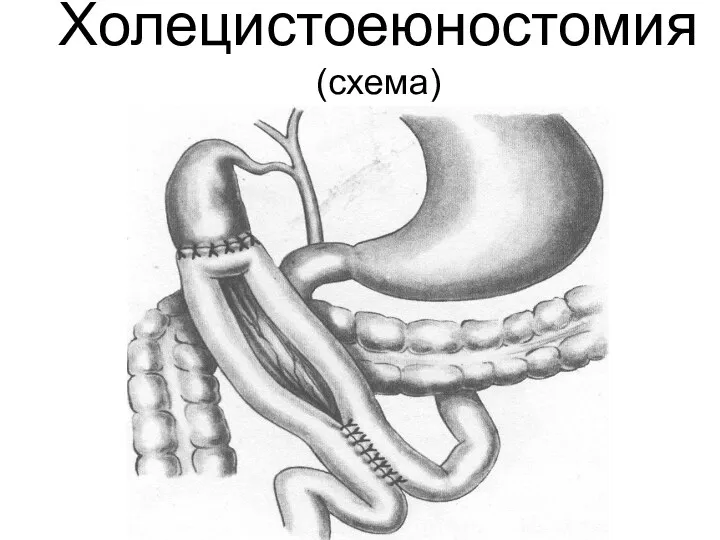 Холецистоеюностомия (схема)