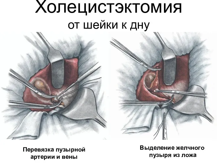 Холецистэктомия от шейки к дну Перевязка пузырной артерии и вены Выделение желчного пузыря из ложа