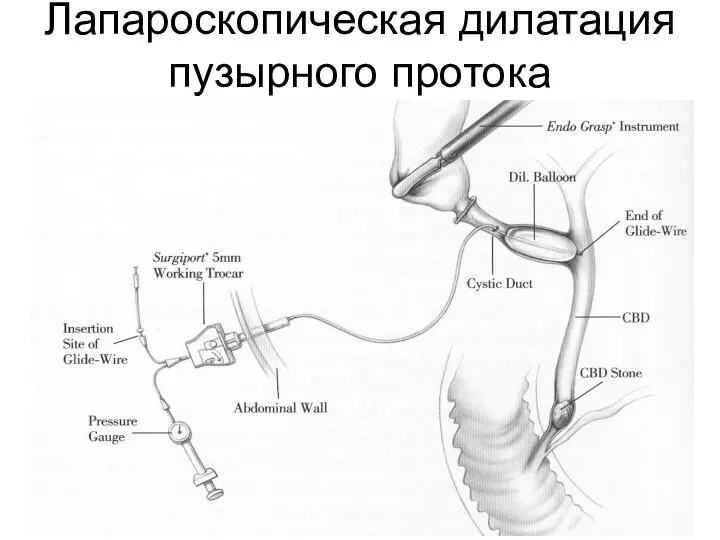 Лапароскопическая дилатация пузырного протока