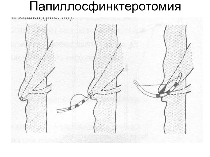 Папиллосфинктеротомия