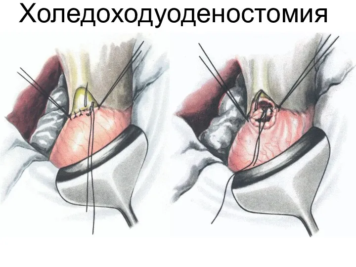 Холедоходуоденостомия