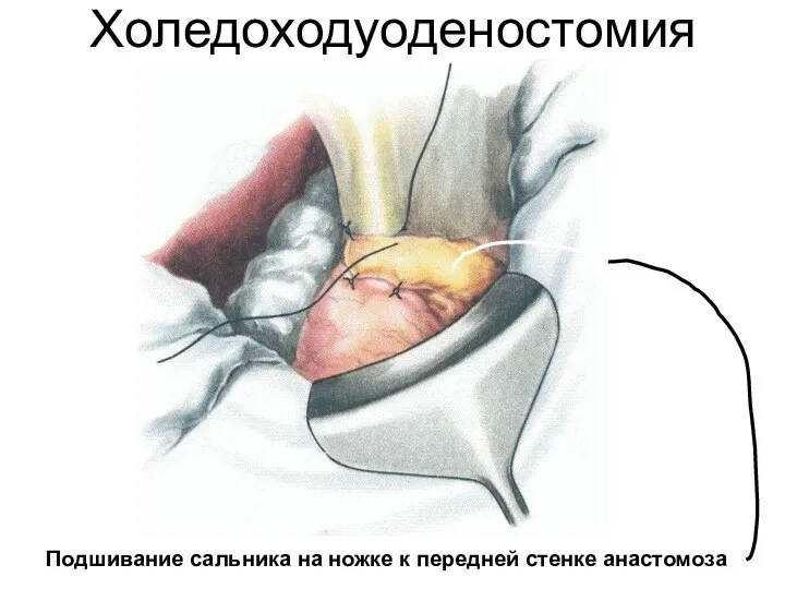 Холедоходуоденостомия Подшивание сальника на ножке к передней стенке анастомоза