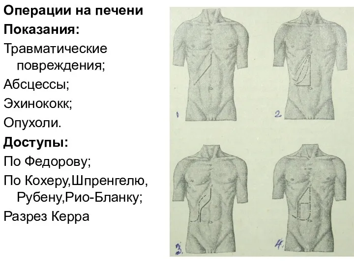 Операции на печени Показания: Травматические повреждения; Абсцессы; Эхинококк; Опухоли. Доступы: