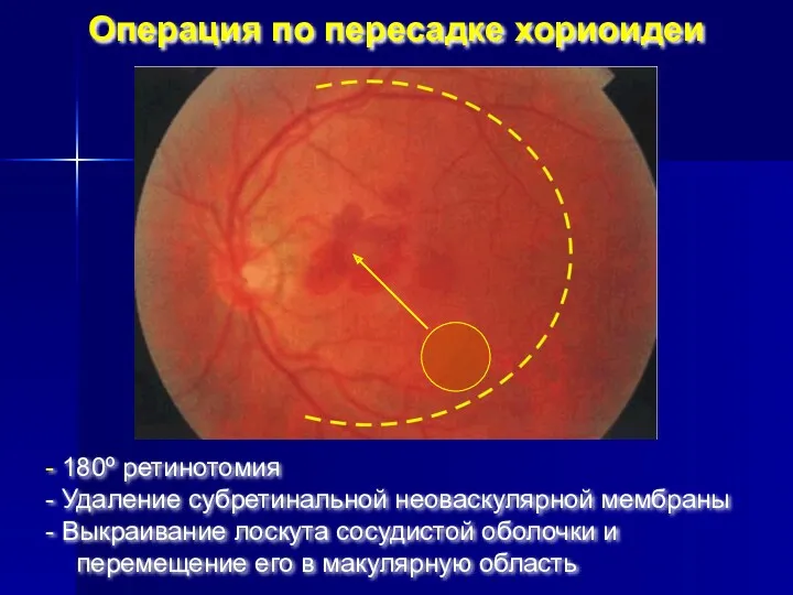Операция по пересадке хориоидеи 180º ретинотомия Удаление субретинальной неоваскулярной мембраны