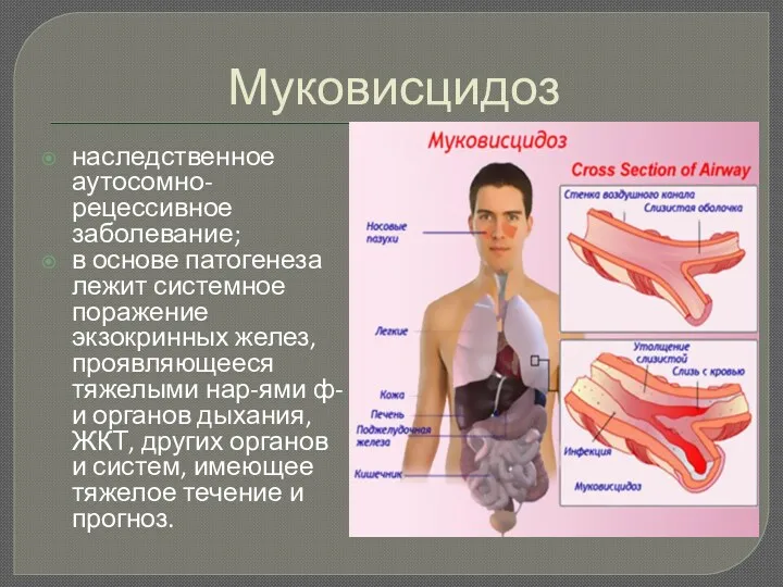 Муковисцидоз наследственное аутосомно-рецессивное заболевание; в основе патогенеза лежит системное поражение