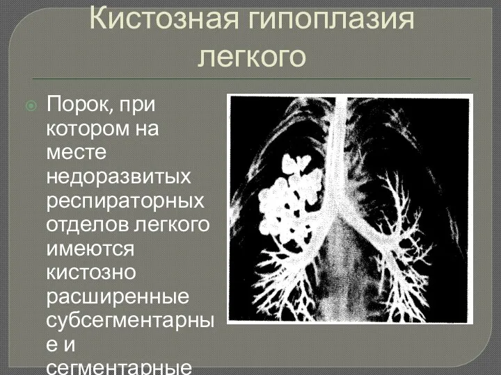 Кистозная гипоплазия легкого Порок, при котором на месте недоразвитых респираторных