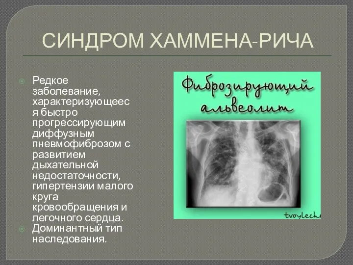 СИНДРОМ ХАММЕНА-РИЧА Редкое заболевание, характеризующееся быстро прогрессирующим диффузным пневмофиброзом с