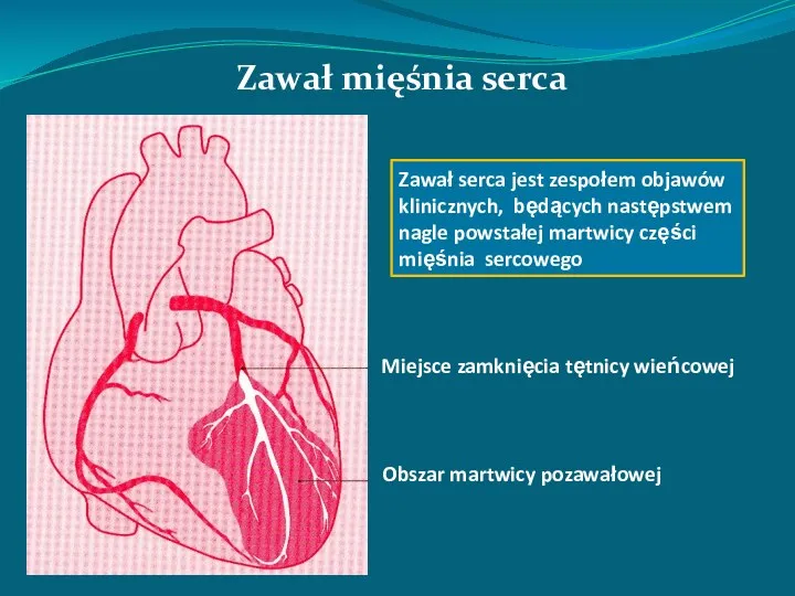 Zawał mięśnia serca Miejsce zamknięcia tętnicy wieńcowej Obszar martwicy pozawałowej