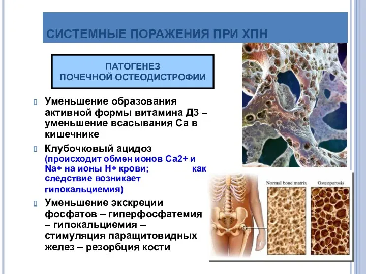 СИСТЕМНЫЕ ПОРАЖЕНИЯ ПРИ ХПН Уменьшение образования активной формы витамина Д3