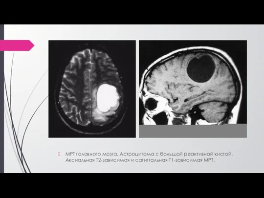 МРТ головного мозга. Астроцитома с большой реактивной кистой. Аксиальная Т2-зависимая и сагиттальная Т1-зависимая МРТ.