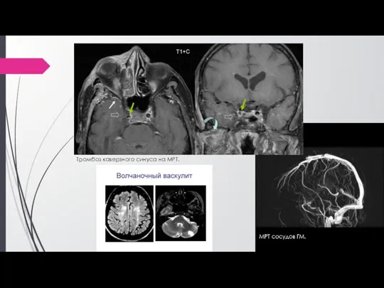 Тромбоз каверзного синуса на МРТ. МРТ сосудов ГМ.