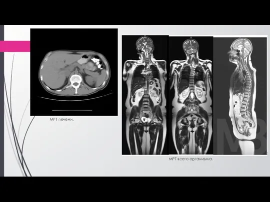 МРТ печени. МРТ всего организма.