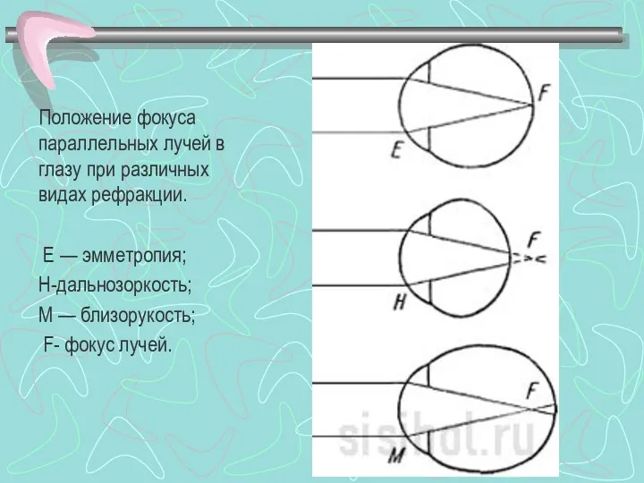 Положение фокуса параллельных лучей в глазу при различных видах рефракции. Е — эмметропия;