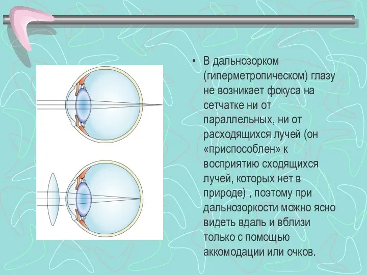 В дальнозорком (гиперметропическом) глазу не возникает фокуса на сетчатке ни