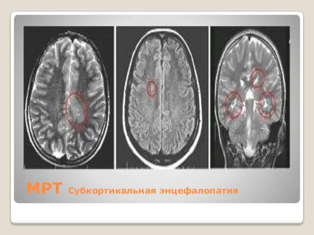 МРТ Субкортикальная энцефалопатия