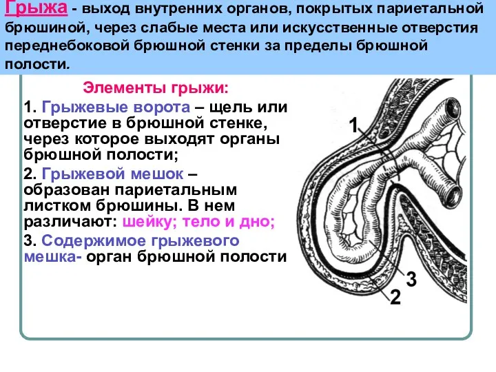 Грыжа - выход внутренних органов, покрытых париетальной брюшиной, через слабые