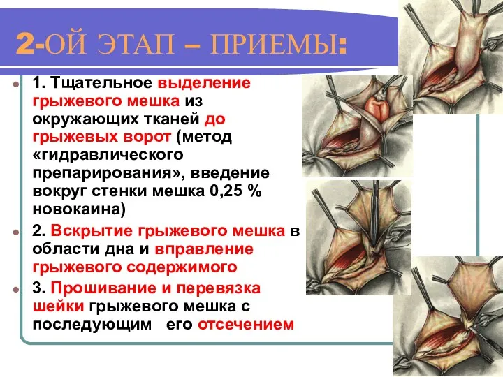 2-ОЙ ЭТАП – ПРИЕМЫ: 1. Тщательное выделение грыжевого мешка из окружающих тканей до