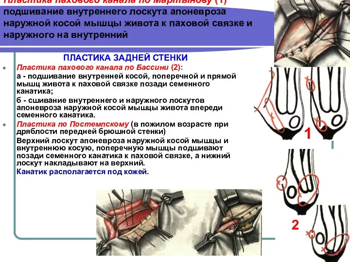 Пластика пахового канала по Мартынову (1) подшивание внутреннего лоскута апоневроза