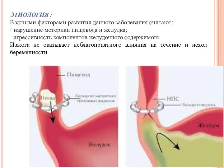 ЭТИОЛОГИЯ : Важными факторами развития данного заболевания считают: · нарушение