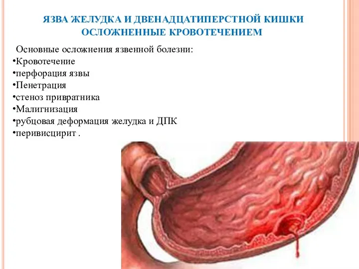 ЯЗВА ЖЕЛУДКА И ДВЕНАДЦАТИПЕРСТНОЙ КИШКИ ОСЛОЖНЕННЫЕ КРОВОТЕЧЕНИЕМ Основные осложнения язвенной