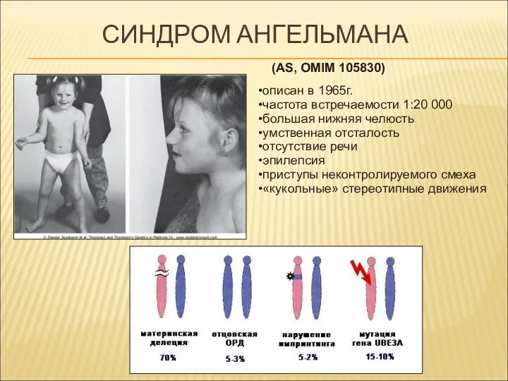 СИНДРОМ АНГЕЛЬМАНА (AS, OMIM 105830) описан в 1965г. частота встречаемости