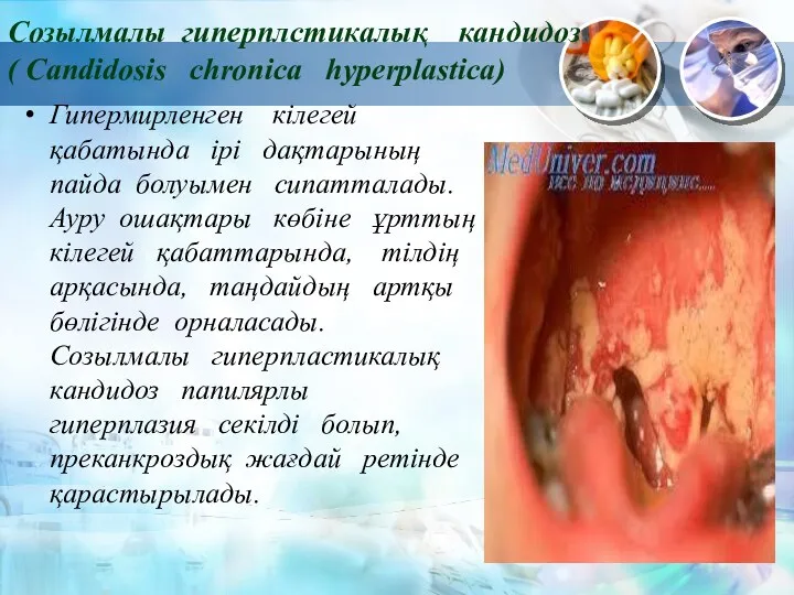 Созылмалы гиперплстикалық кандидоз ( Candidosis chronica hyperрlastica) Гипермирленген кілегей қабатында