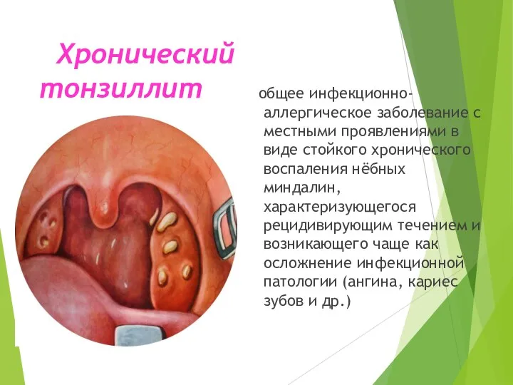 Хронический тонзиллит общее инфекционно-аллергическое заболевание с местными проявлениями в виде